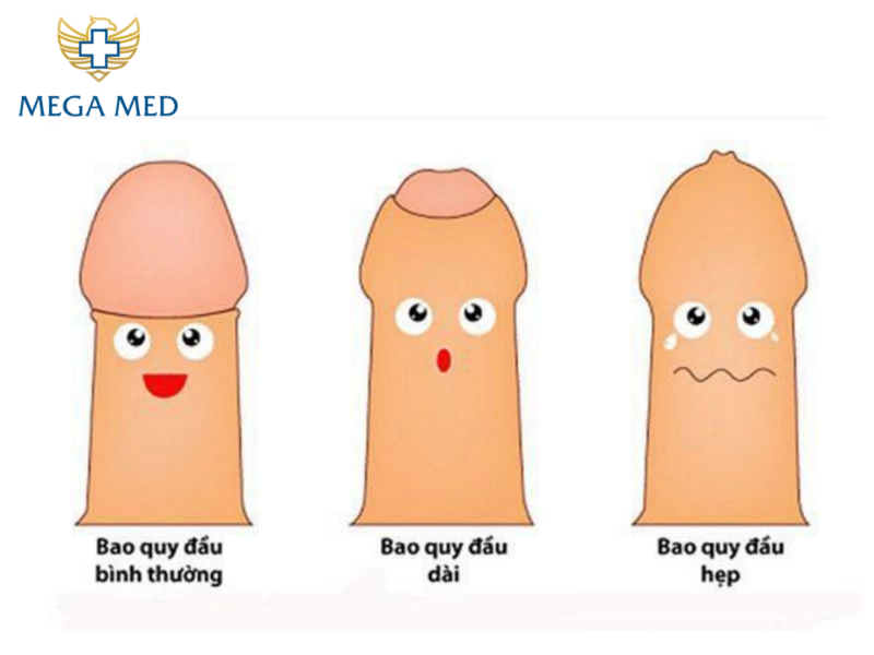 Tình trạng dài và hẹp bao quy đầu